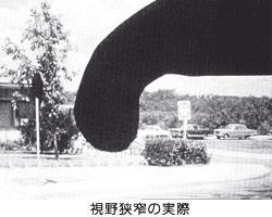 視野狭窄の実際