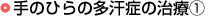 手のひらの多汗症の治療(1)