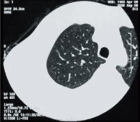 「COPD」