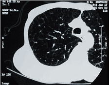「COPD」