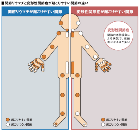 関節リウマチ