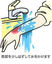 やけどの救急処置