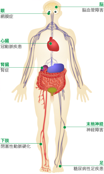 重大な糖尿病合併症